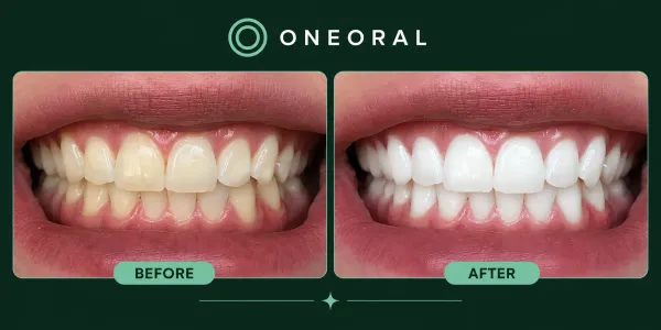 AI whitening before and after preview