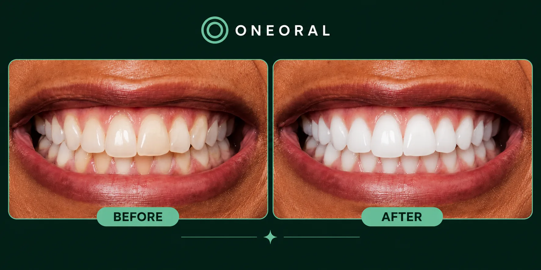 AI whitening before and after preview